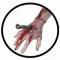 Metallbolzen In Der Hand - Wunde